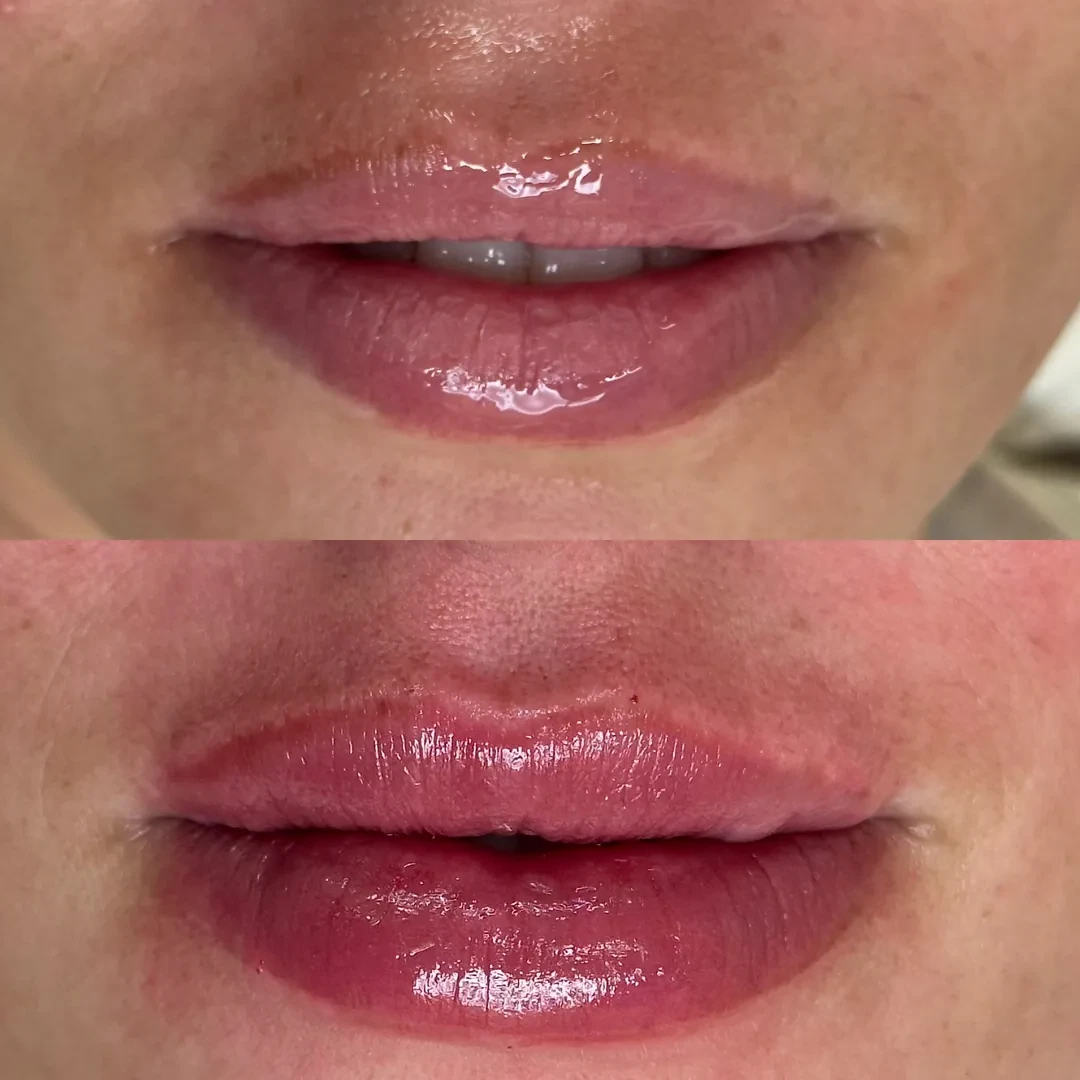 Antes e depois de preenchimento labial — lábios com mais volume e contorno definido